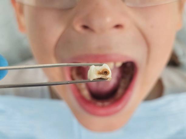 Best Broken or Cracked Tooth Emergency Dentist in St Marys, WV